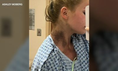 Elmhurst dad, daughter describe moment they were struck by lightning: ‘I thought my dad was dead’