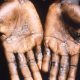 US monkeypox cases climb, another reported in Colorado