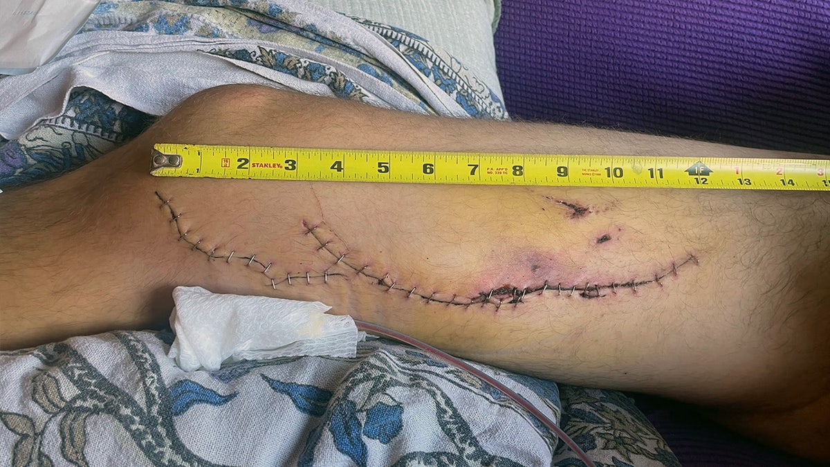 Great White Shark attack bite with stitches