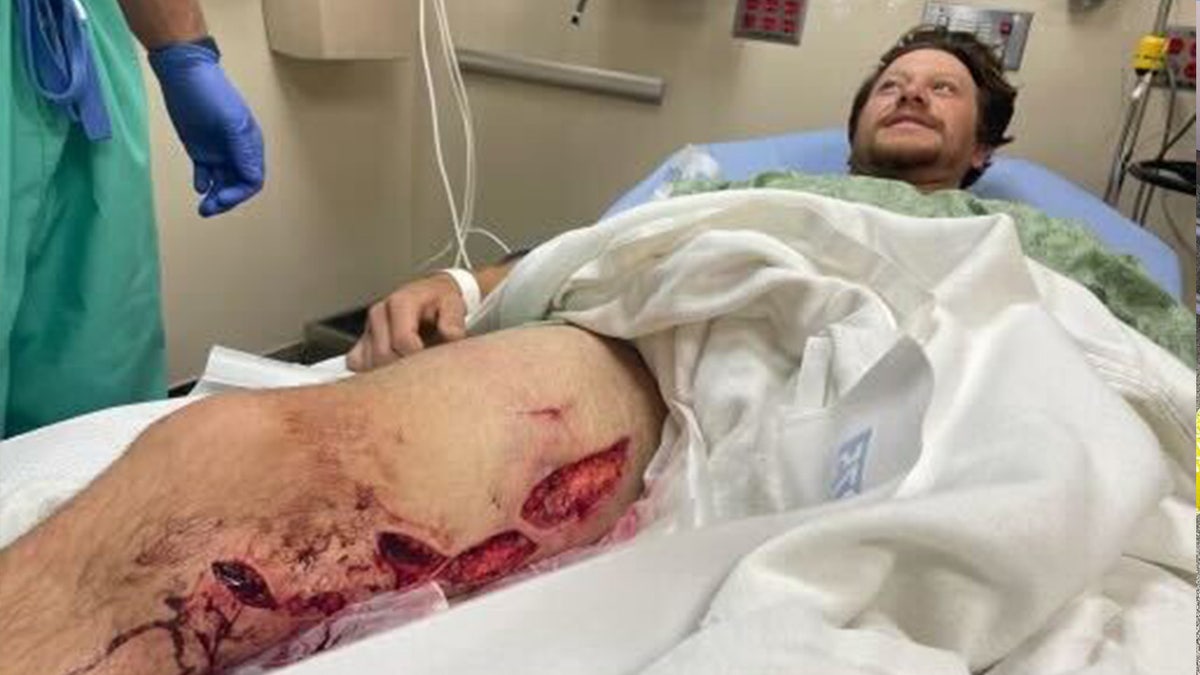 california man's open wounds from shark attack