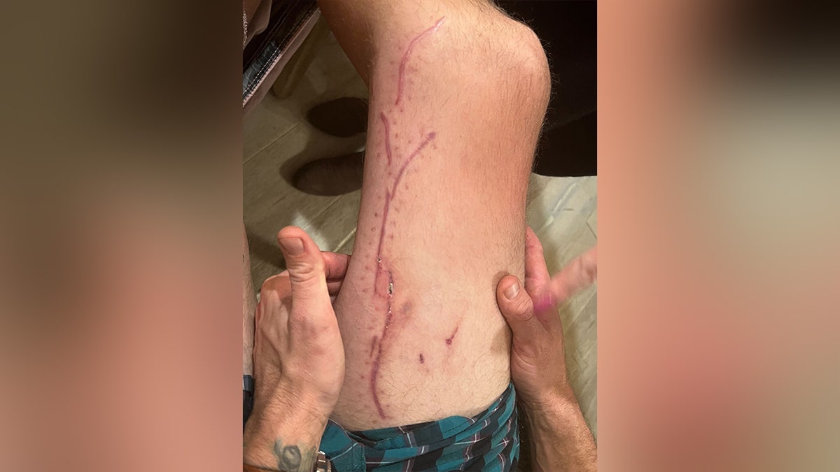 Shark attack survivor shows stiches on his leg