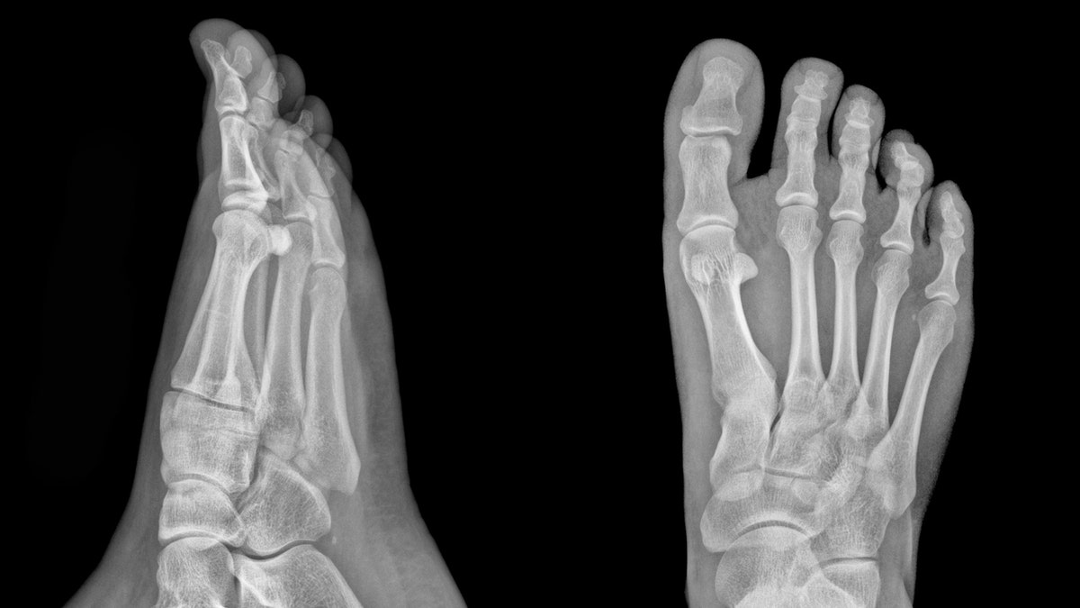 X-ray of feet