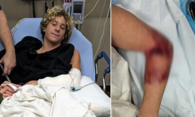 Florida teen surfer attacked by shark, says it ‘could have been so much worse’