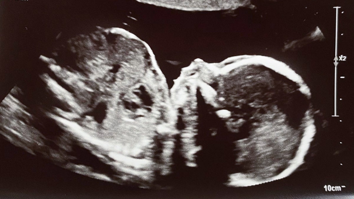 A baby at 19 weeks gestation