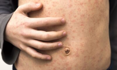 Measles outbreak continues in Texas, cases double: investigation underway