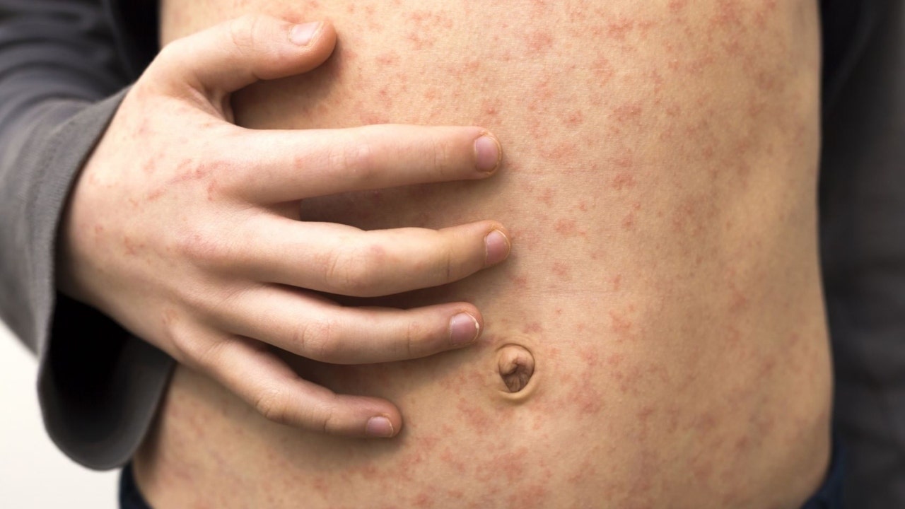 Measles outbreak continues in Texas, cases double: investigation underway