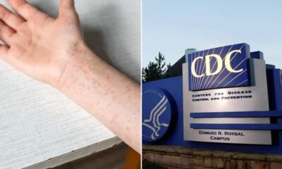 Texas measles outbreak swells to 561 cases, CDC sends more help