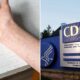 Texas measles cases are underreported, response hurt by funding cuts, CDC scientist says