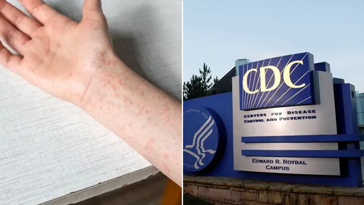 Texas measles cases are underreported, response hurt by funding cuts, CDC scientist says
